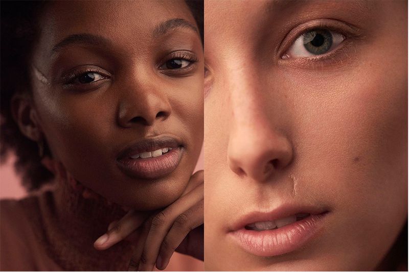 Meet 5 Models with Facial Scars (Teen Vogue)